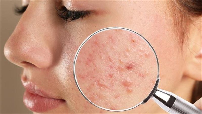 حب الشباب
