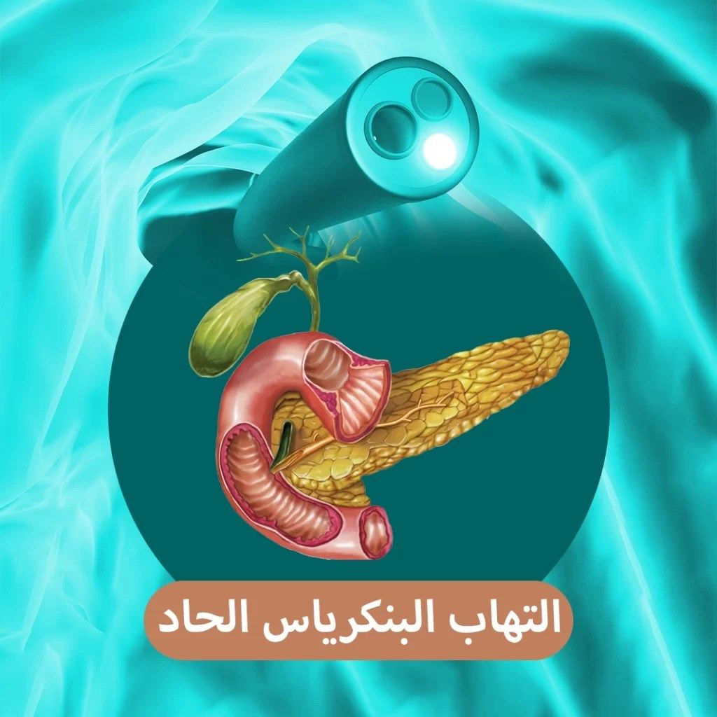 التهاب البنكرياس الحاد