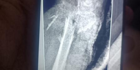 مستشفى
الفيوم
العام
تنقذ
حياة
سيدة
مسنّة
بعد
سقوط
من
علو
وتجري
جراحة
ميكروسكوبية
دقيقة
باليد