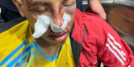 إصابة لاعب كرة قدم بكسر في الأنف إثر اعتداء آخرين عليه داخل ملعب بالشرقية