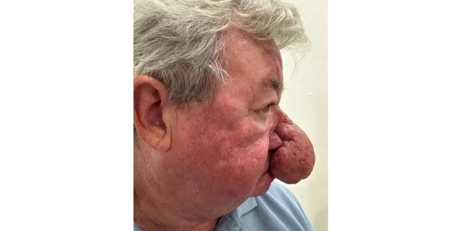 أنف اسكتلندي.. حبة بطاطا