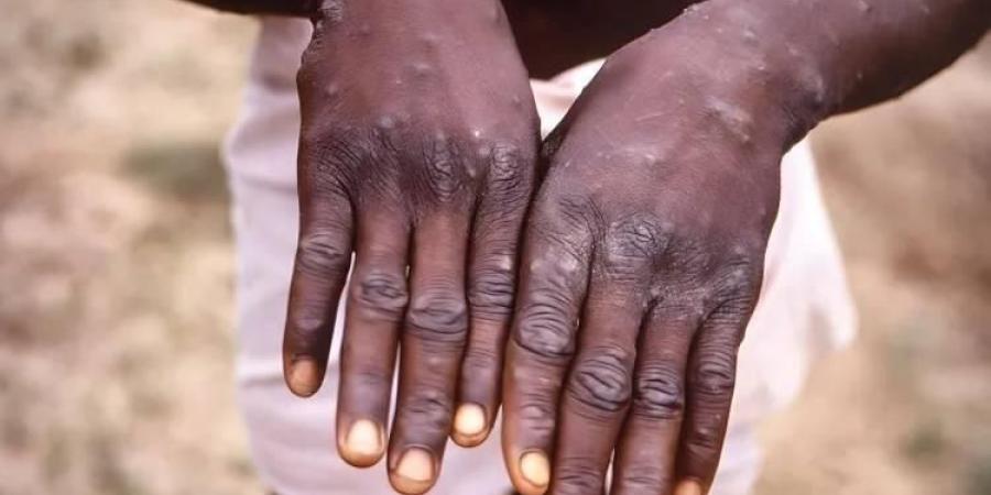 جدري القردة يعود للانتشار.. تسجيل أكثر من 2800 إصابة و17 وفاة في إفريقيا