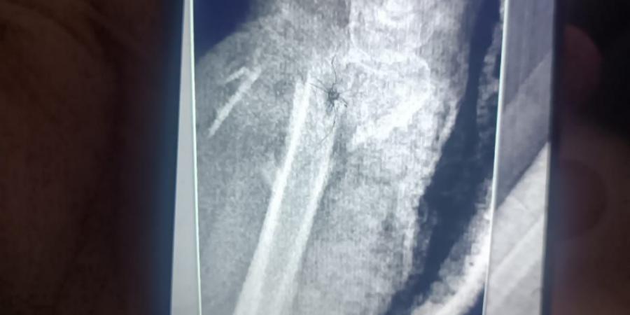 مستشفى
      الفيوم
      العام
      تنقذ
      حياة
      سيدة
      مسنّة
      بعد
      سقوط
      من
      علو
      وتجري
      جراحة
      ميكروسكوبية
      دقيقة
      باليد