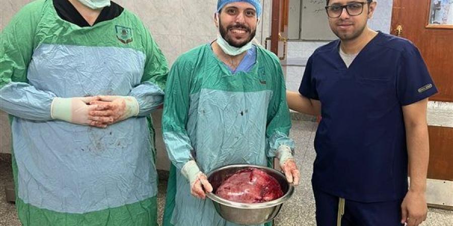 فريق طبي بجامعة أسيوط ينجح في استئصال ورم مبيضي ضخم لسيدة خمسينية