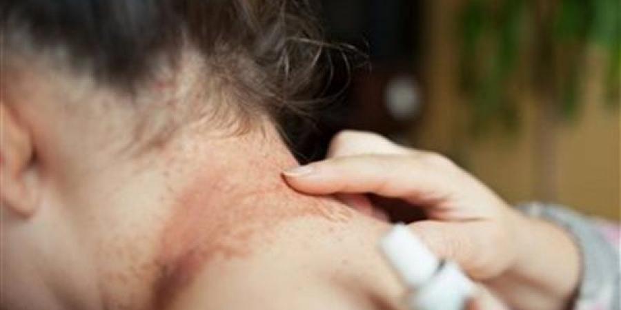 أعراض وأسباب التينيا وطرق العلاج والوقاية