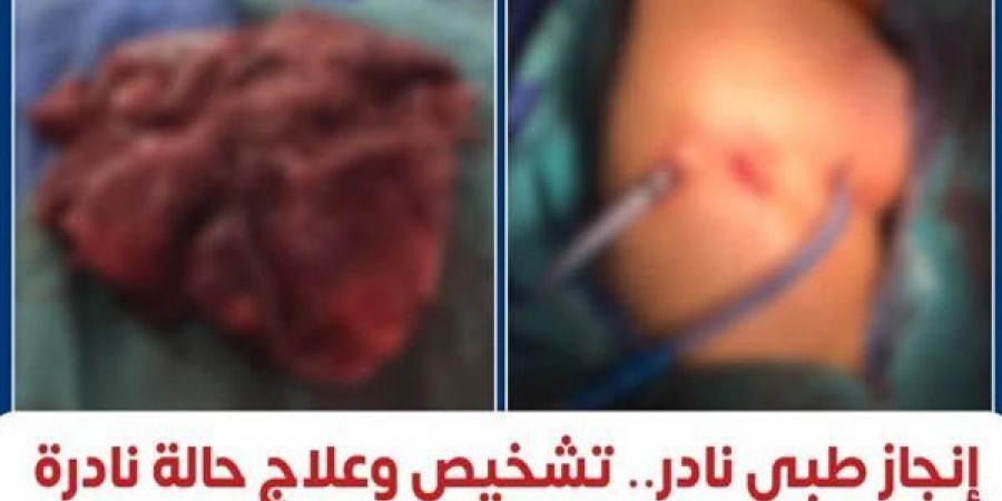 إنجاز طبي نادر، معهد القلب ينجح في تشخيص وعلاج أول حالة موثقة عالميًا لبطانة الرحم داخل الرئة