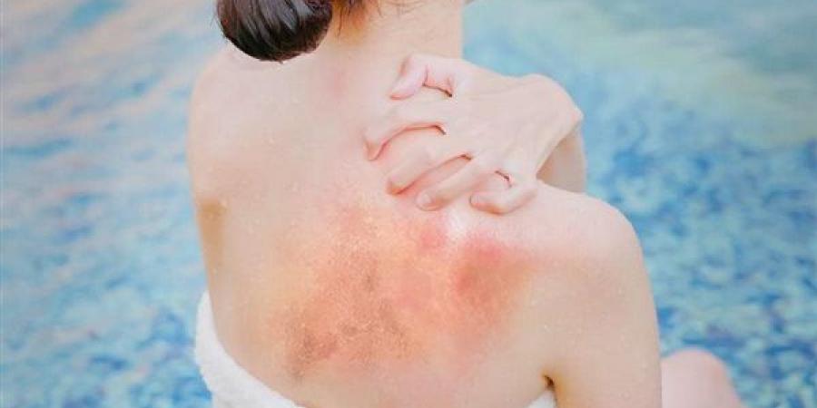 أسباب وأعراض طفح الكلور الجلدي بعد السباحة وكيفية علاجه بالمنزل