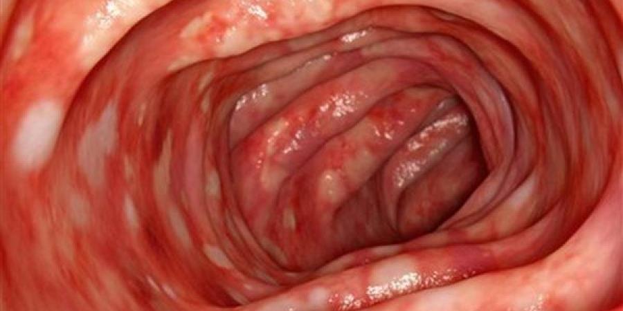 أعراض وأسباب إلتهاب القولون المجهري وأسباب الإصابة به - النيل نيوز